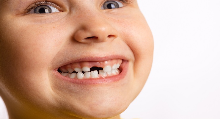 Hidden Risks of Ignoring a Broken Tooth